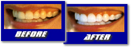 ProWhite Teeth Whitening Systems